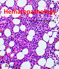Intrasinusoidal erythroblast localisation in a case of secondary acute myeloid leukemia