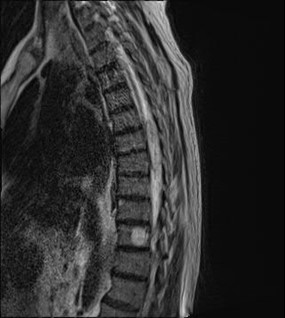 MRI of the spine shows an epidural mass