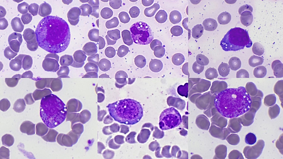 Bone marrow aspirate showing vacuolation in maturing myeloid and erythroid precursor cells