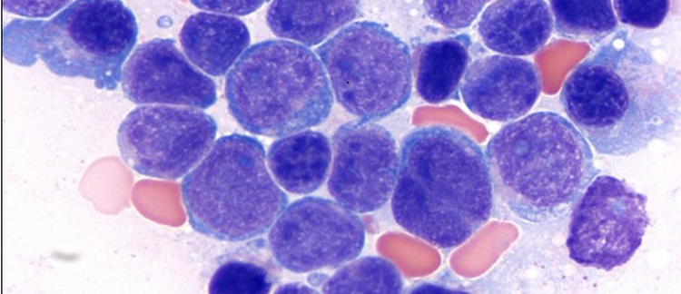 B-Lymphoblastic Leukemia/Lymphoma with CRLF2 Overexpression: A Case Study of Three Patients